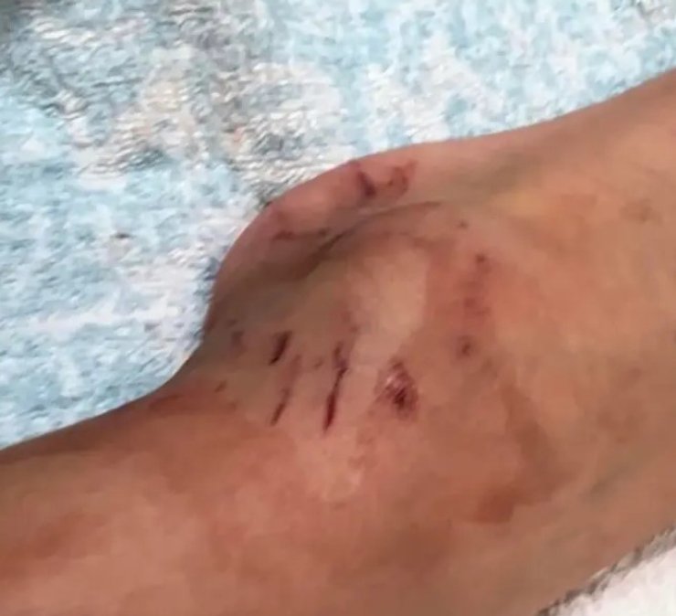 укус питона