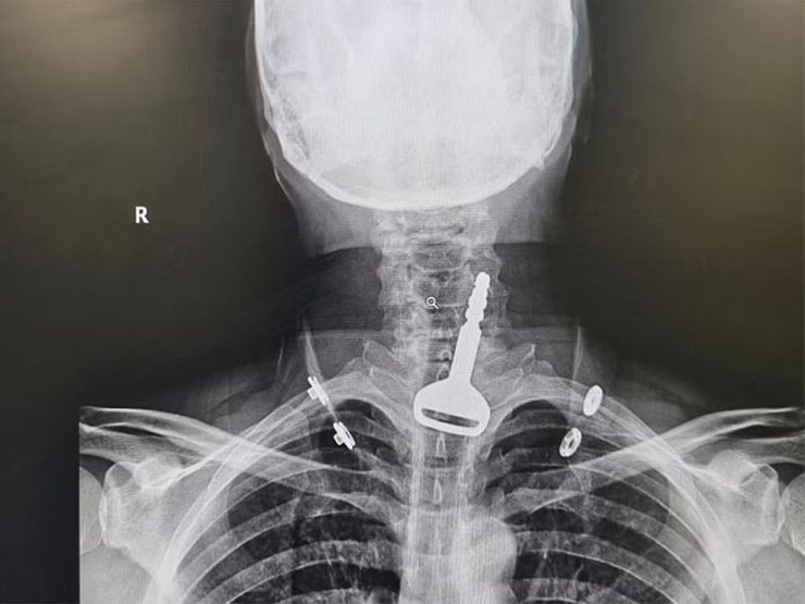 Проглотил ключ от автомобиля, ключ, проглотил ключ, дыхательные пути, операция, снимок, рентген