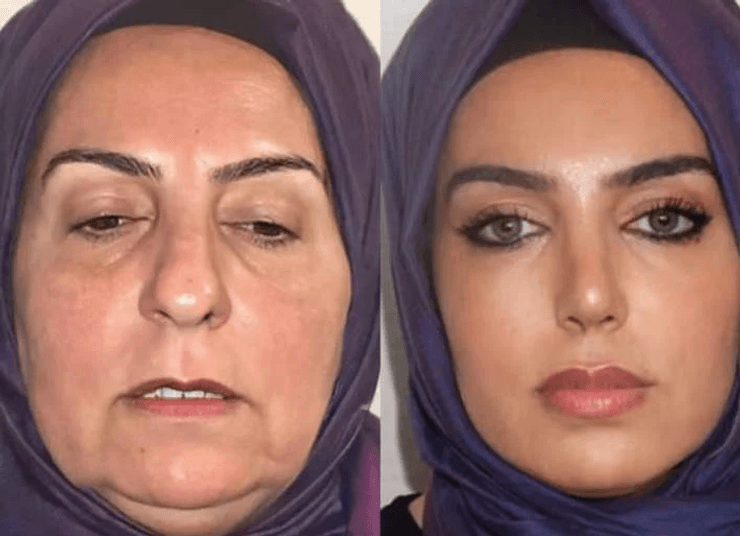 Пластическая операция, операция на лице, фото до и после, клиника, ринопластика, хирург, доктор, внешний вид,