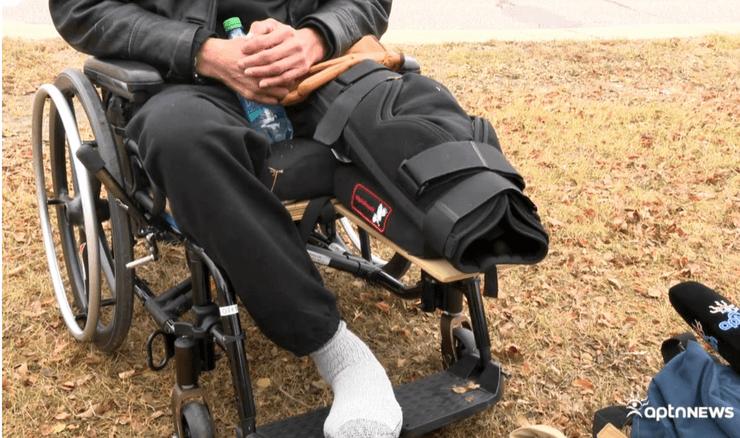 чоловік ампутація ноги