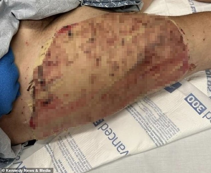 Ожоги третьей степени