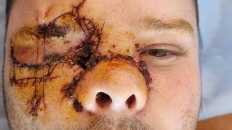 Ранения бойца ВСУ, пострадавшего во время обстрела