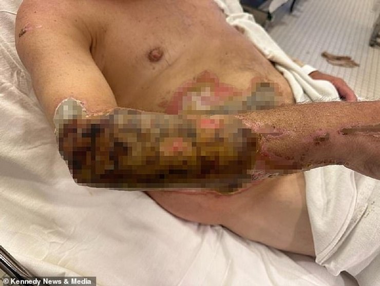 Ожоги третьей степени