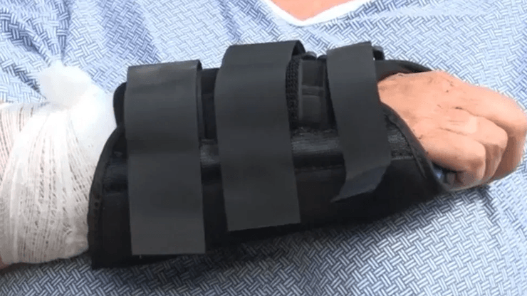 Ведмідь, тварина, дика тварина, чорний ведмідь, ведмідь напав на собаку. жінка врятувала собаку, бійка з ведмедем, рука, шви, наклали шви