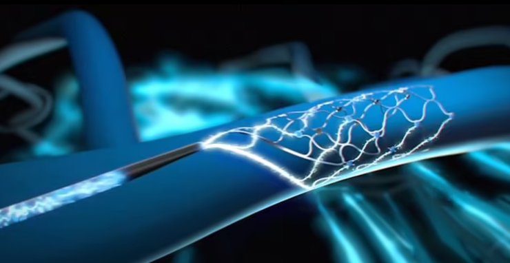 мозок, імплант, Synchron