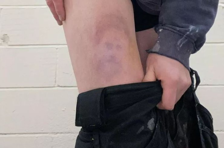 синяк лицо принц Гарри