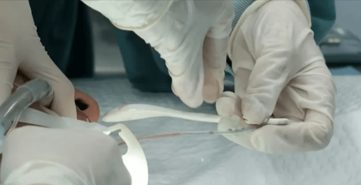 Врачи вытащили кофейную ложку