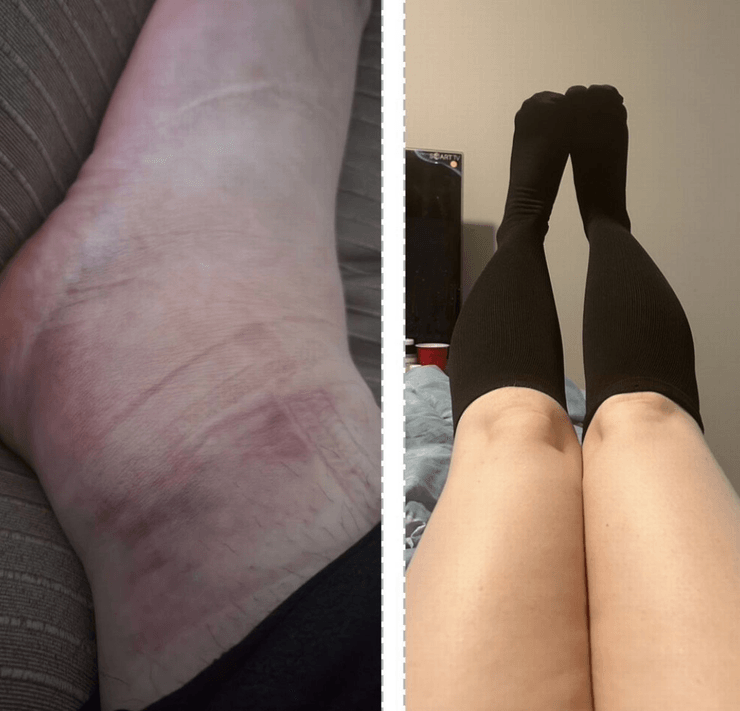 Жінка скинула вагу, рідкісний діагноз, рідкісна хвороба, дізналася через Facebook, випадкове відео змінило життя, страждала від сильного болю