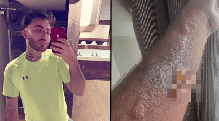 Мужчина, ожог, рука,