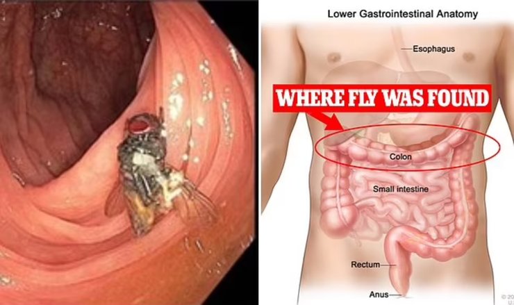 Муха в желудке человека, живая муха, живая муха в кишечнике, необычный случай