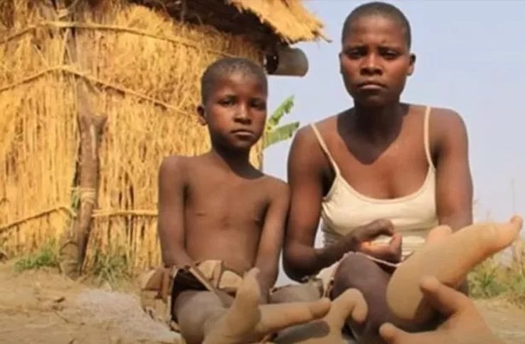 Люди из племени Вадома, люди-страусы, синдром "клешни омара", тайна племени, загадка племени, ноги без трех пальцев