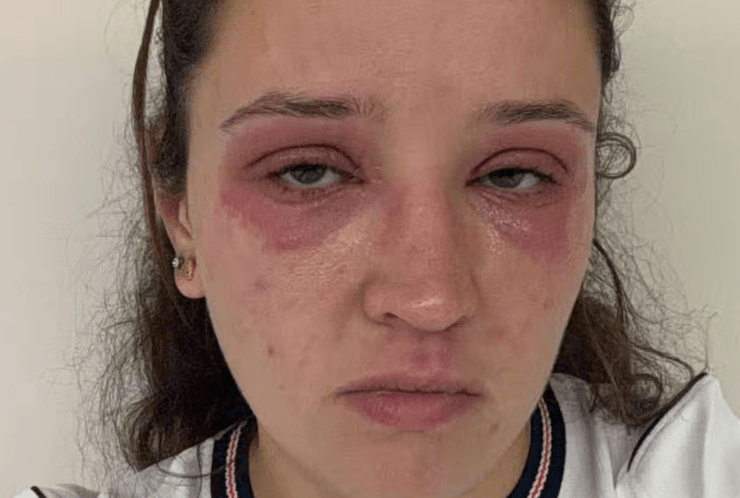 Наречена розповіла про жах після нарощування вій