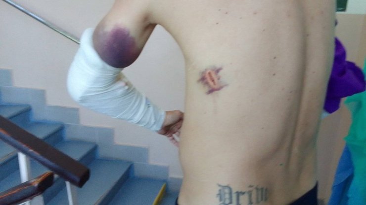 Медіа показали травми постраждалого у справі про побиття військового у Кіровоградській області