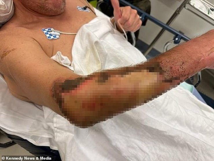 ожоги третьей степени