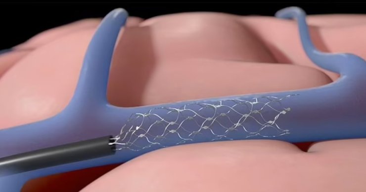 мозок, імплант, Synchron