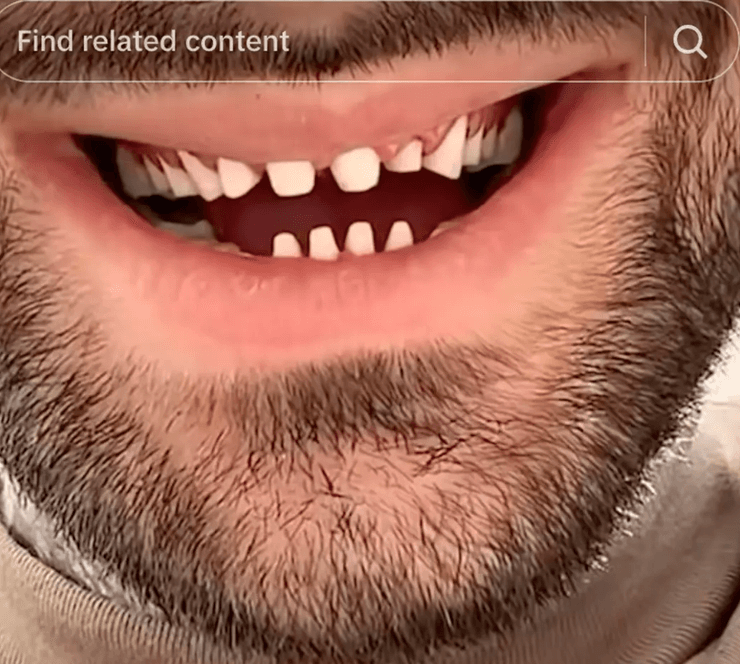 Крупный план подпиленных зубов пациента, подготовленных для установки виниров