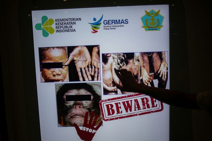 віспа мавп, мавпа віспа, спалах віспи мавп, вірус віспи мавп, спалах віспи в Європі, віспа в Європі, спалах вірусу, вірусна інфекція, віспа мавп симптоми, натуральна віспа, чорна віспа, рідке захворювання, випадок, віспа мавп вакцинація