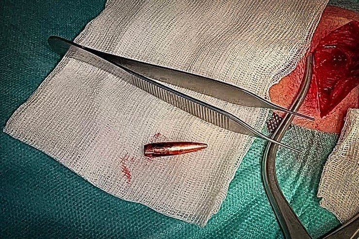 Лікарі визначили розміщення кулі до міліметра і змогли її видалити