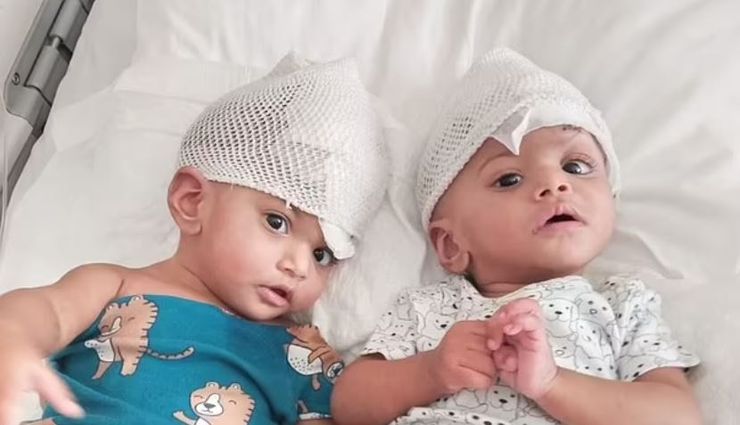 Сіамські близнюки, Мінала та Мірхау з Пакистану розділили, складна операція, фото, діти, аномалії, візуальні діагнози