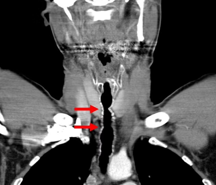 Волосся росте в горлі затятого курця, дивні діагнози, захворювання внаслідок куріння, розлади, курйози, фото, Австрія