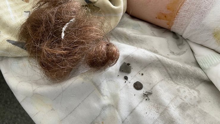 22-летняя Анастасия получила ранения во время двойного удара "Искандерами" по Черкасской Лозовой на Харьковщине