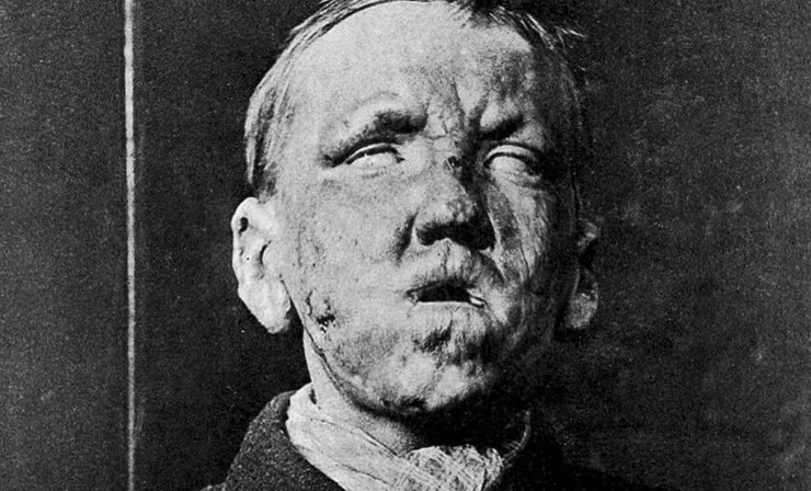 проказа, больной проказой, лепра, лепрозорий, эпидемия, пандемия, бубонная чума, средневековые болезни, загадочная болезнь, страшная болезнь, болезнь из прошлого