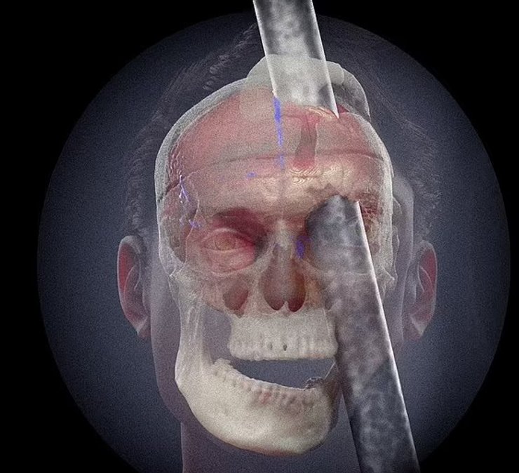 Финеас Гейдж