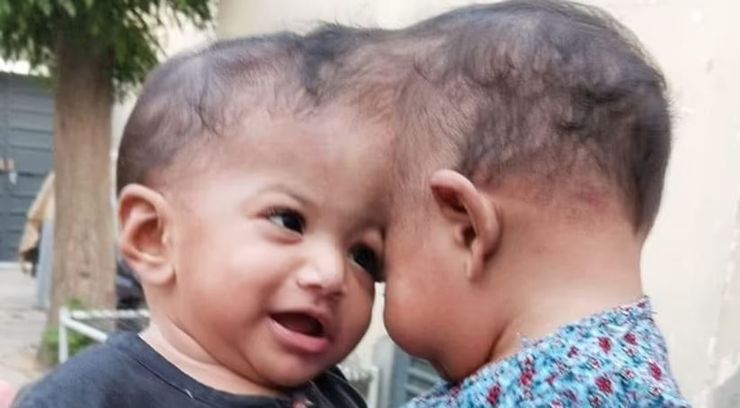 Сіамські близнюки, Мінала та Мірхау з Пакистану розділили, складна операція, фото, діти, аномалії, візуальні діагнози