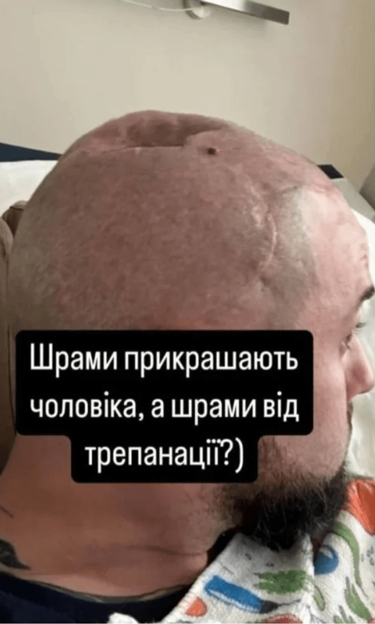 Трепанация черепа