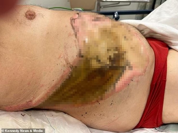 ожоги третьей степени