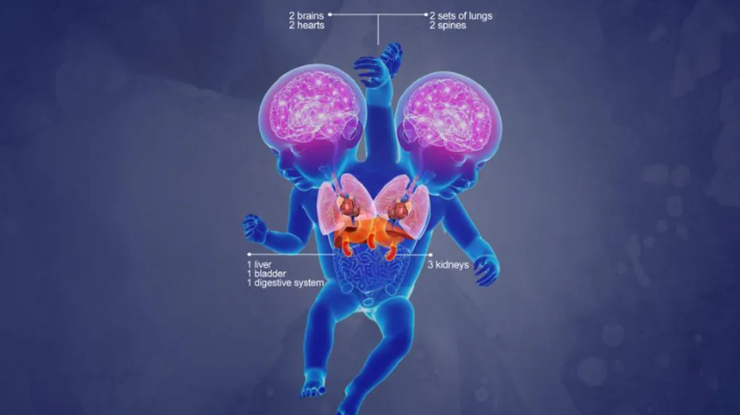 Сиамские близняшки, аномалии, болезни, диагнозы, фото, дети, Великобритания