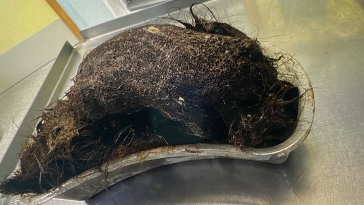 кілограм волосся з шлунку