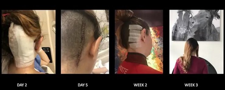 женщина, опухоль мозга