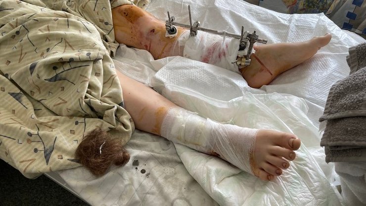 22-летняя Анастасия получила ранения во время двойного удара "Искандерами" по Черкасской Лозовой на Харьковщине