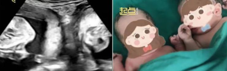 Ли из Китая живет с двумя матками, женщина одновременно вынашивает двух детей в разных утробах, как такое возможно