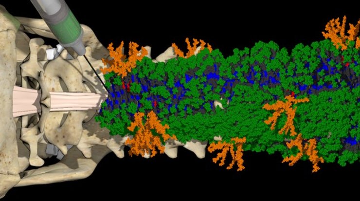 спинной мозг, травма, лечение