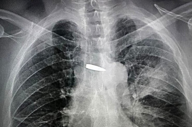 Куля пройшла крізь ліве плече і ліву легеню буквально в міліметрах від серця нацгвардійця