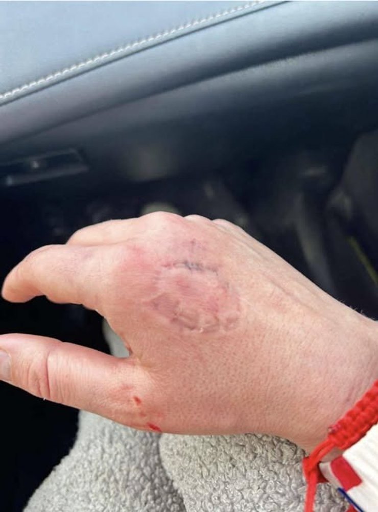 Депутат покусав руку дружині