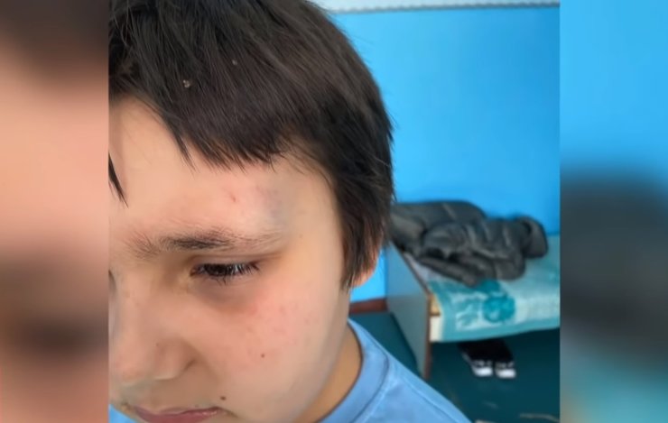 Ребенок, синяки