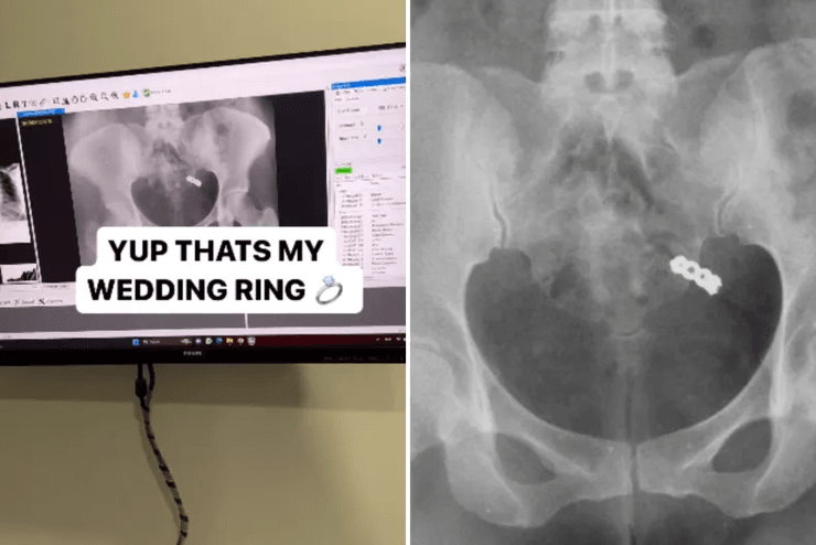 Обручка, каблучка, прикраса, проковтнула каблучку, переплутала каблучку з таблетками, рентген, каблучка в животі, знімок