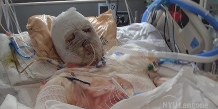 Джо Дімі, пацієнт, фото, операція з пересадки обличчя