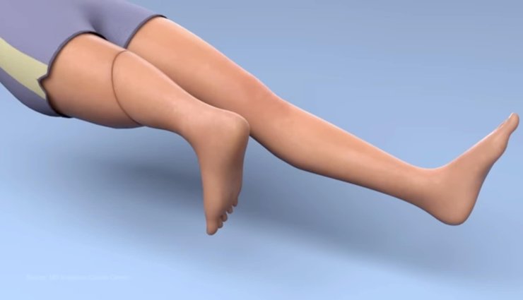 ногу пришили задом наперед, протезирование, рак кости