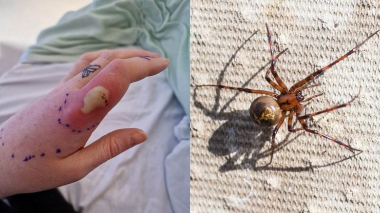 Рука, павук, укус, операція, фальшива чорна вдова