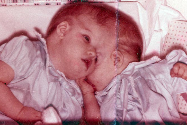 Сиамские близнецы, Книга рекордов Гиннесса, аномалии, курьезы, странные диагнозы, США, фото