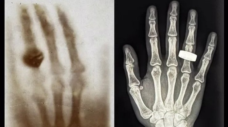 перший рентгенівський знімок людини в космосі