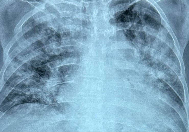 поражение легких