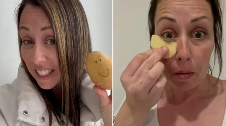 Як позбутися темних кіл під очима за допомогою сирої картоплі, лайфхаки, методи, краса, зовнішність