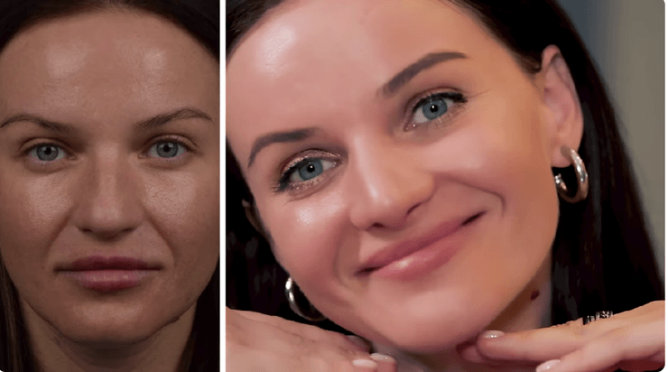 Аліна Доротюк пластика носа