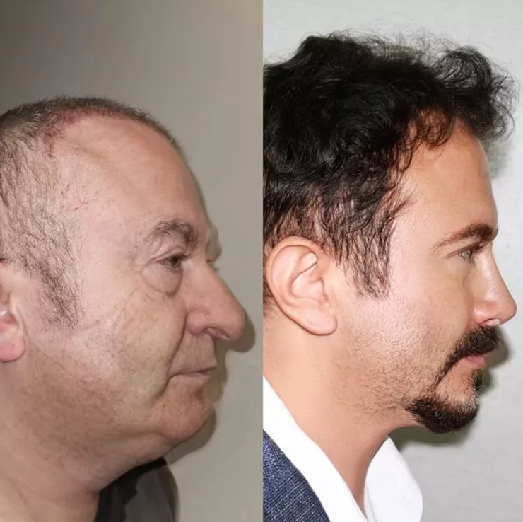 Пластическая хирургия в Турции, операция, изменение внешности, до и после ринопластики, пересадка волос