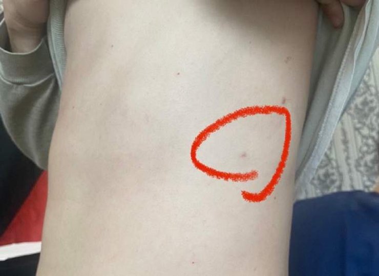 ранение кассетный боеприпас